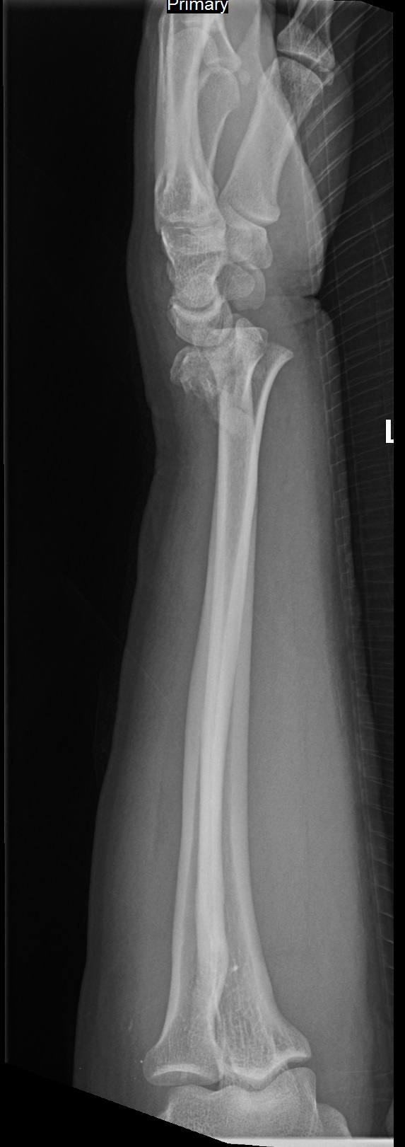 Lateral Wrist X Ray Labeled