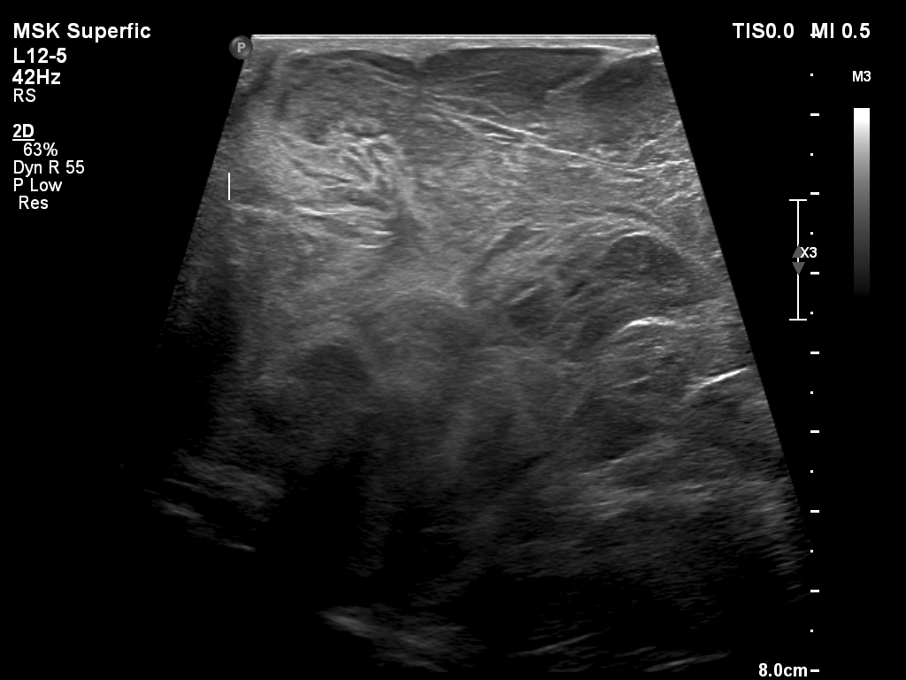 Myxoid Liposarcoma Image 