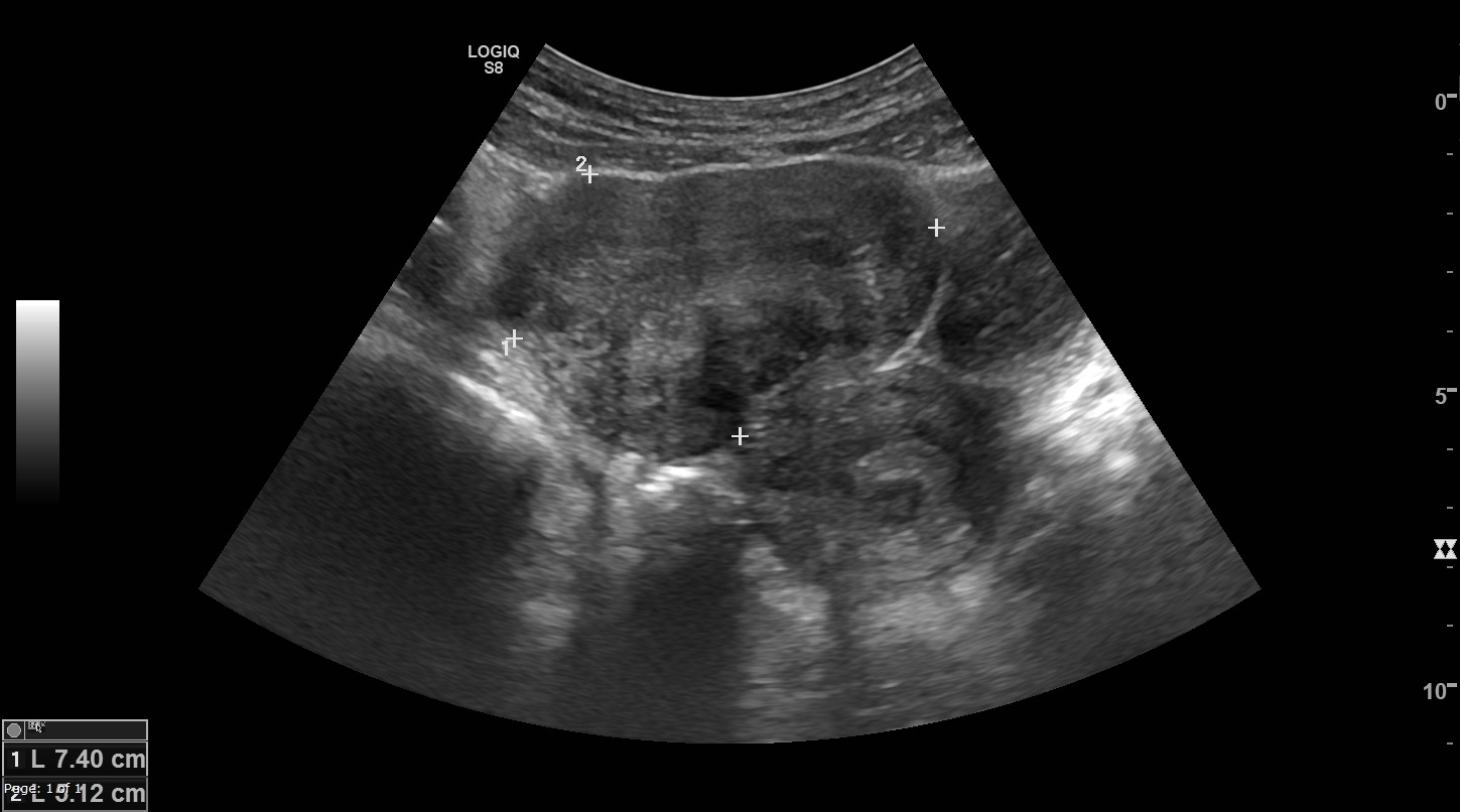 Bridging vessel sign - pedunculated subserosal leiomyoma | Image ...