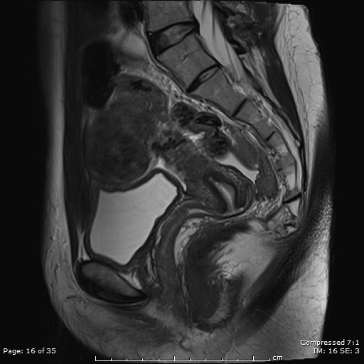 Bridging vessel sign - pedunculated subserosal leiomyoma | Image ...