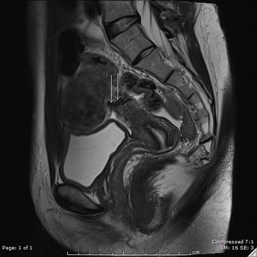 Bridging vessel sign - pedunculated subserosal leiomyoma | Image ...