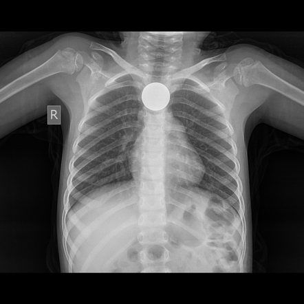 Esophageal foreign bodies | Radiology Reference Article | Radiopaedia.org