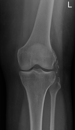 Lateral collateral ligament calcification - knee | Image | Radiopaedia.org