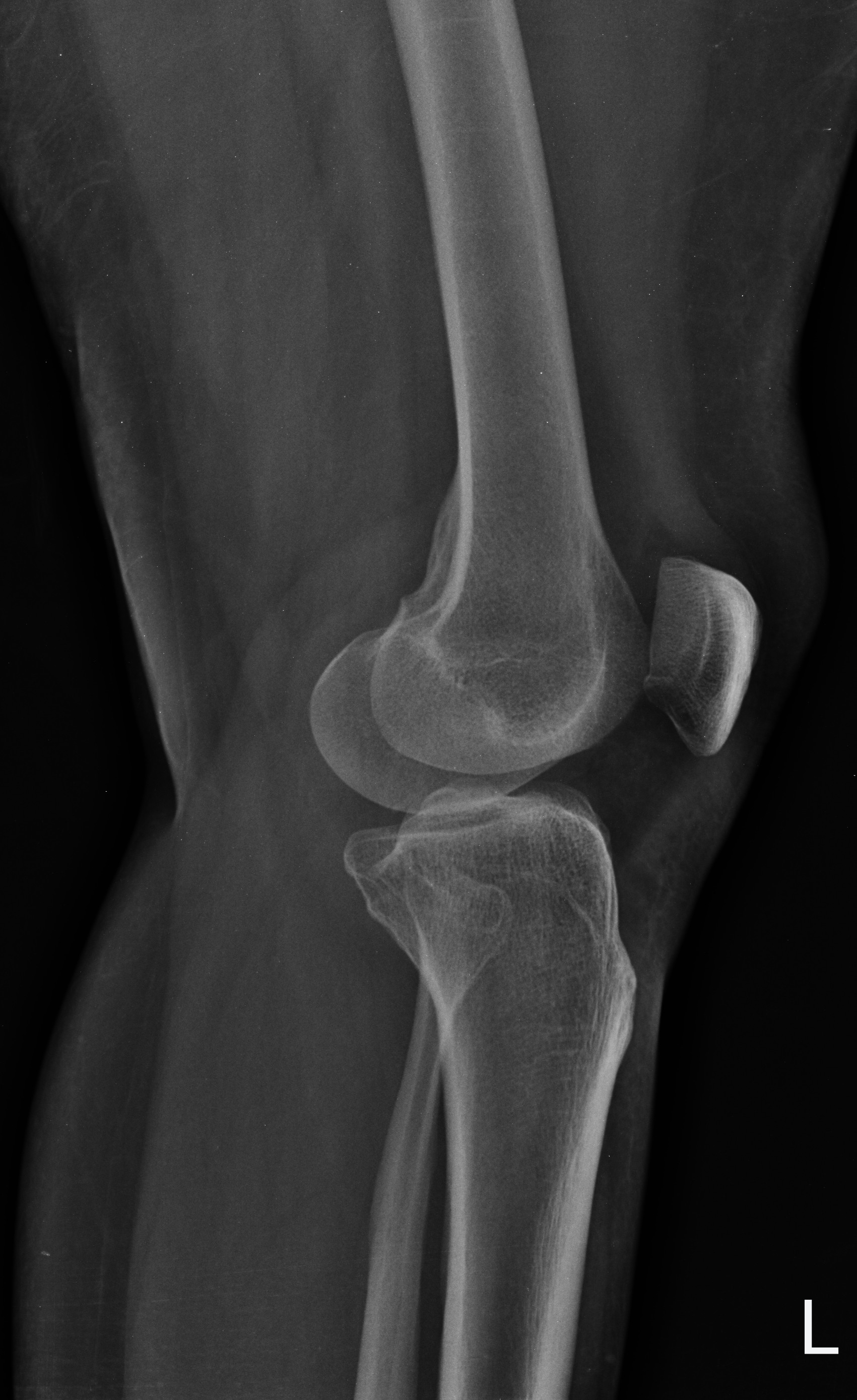 Lateral collateral ligament calcification - knee | Image | Radiopaedia.org