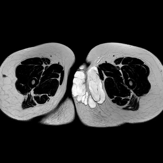 Liposarcoma Pathophysiology Wikidoc