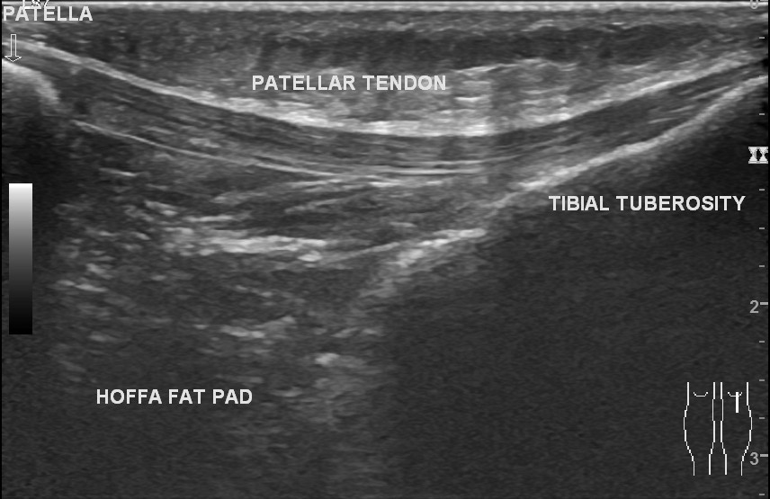 Lateral Collateral Ligament Calcification Knee Image Radiopaedia Org