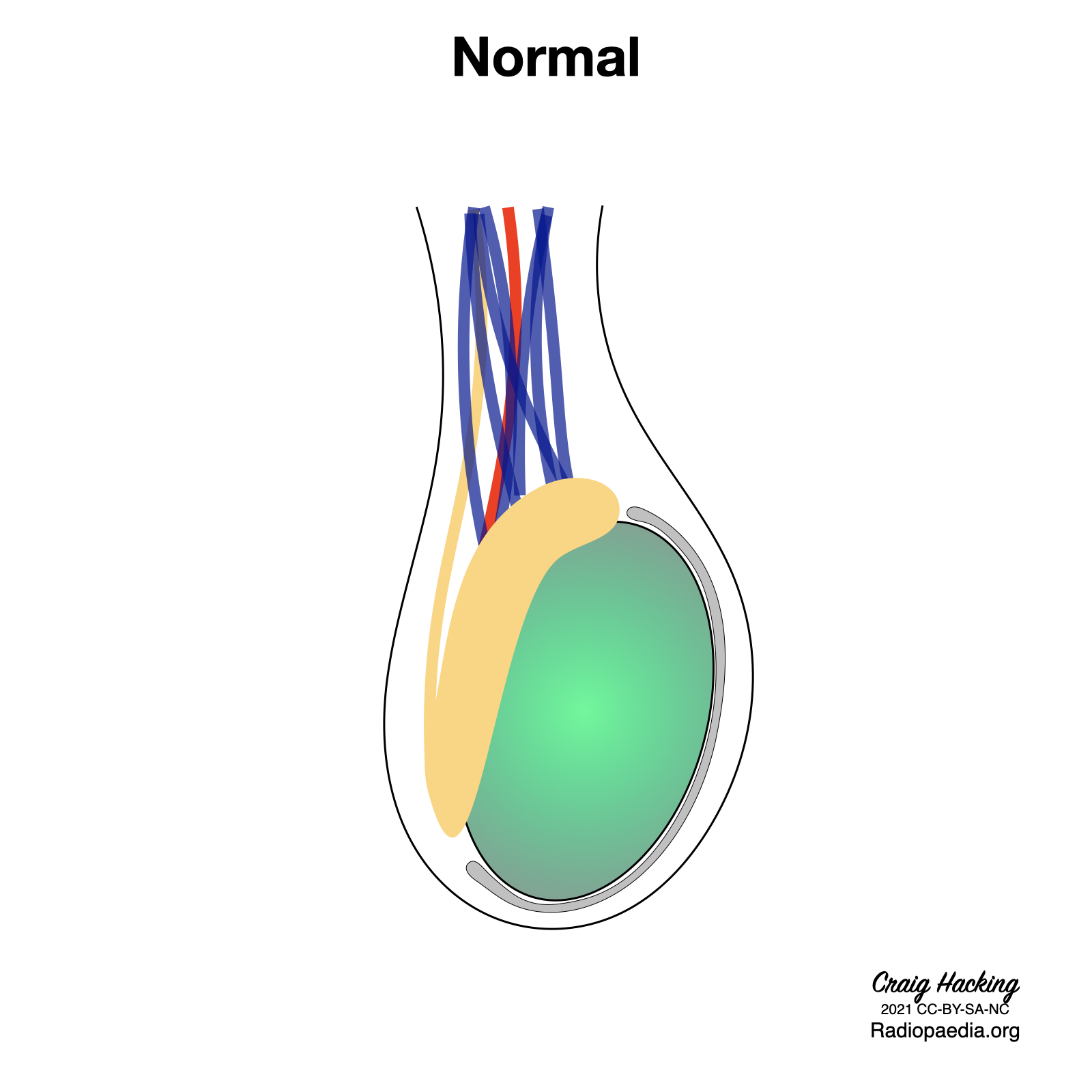 Bell clapper deformity (diagram) | Image | Radiopaedia.org