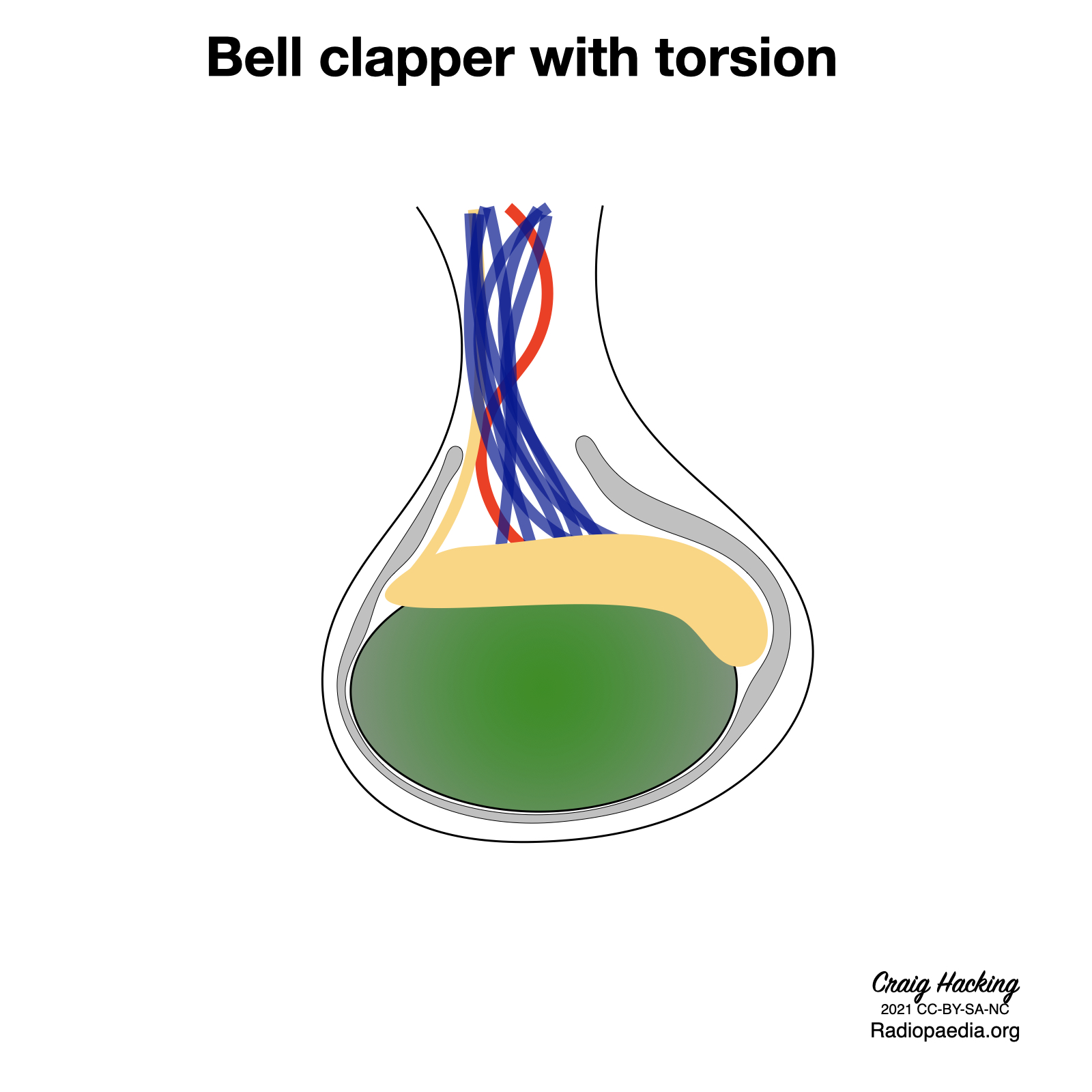 Bell Clapper Deformity Diagram Image 1578