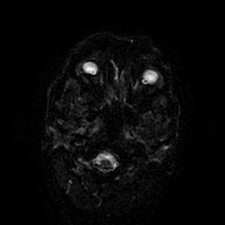 Intracerebral metastasis of glioblastoma multiforme | Image ...