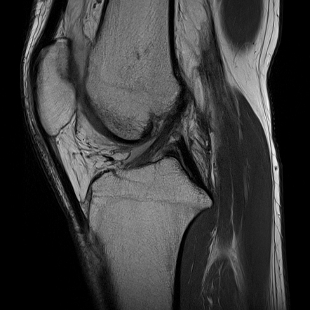 Subchondral femoral condyle fracture and lateral cortical desmoid ...