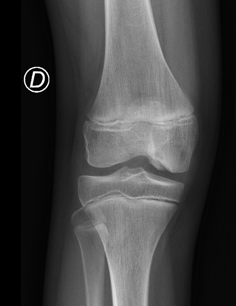 Osteochondritis Dissecans Knee