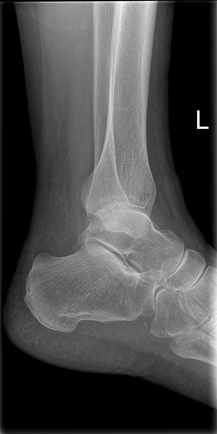 Ankle fracture - Weber A1 | Image | Radiopaedia.org