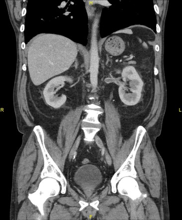 Thrombosis in a circumaortic left renal vein | Image | Radiopaedia.org