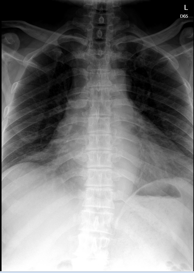 Cardiomegaly with left atrium enlargement | Image | Radiopaedia.org