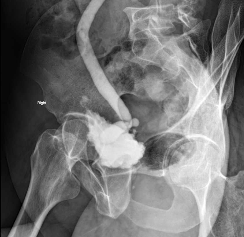 Unilateral vesicoureteral reflux (grade V) | Image | Radiopaedia.org