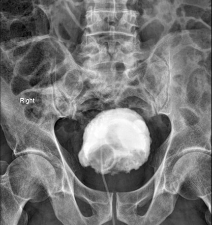 Transitional cell carcinoma (urinary bladder) | Radiology Reference ...