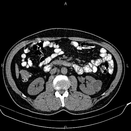 Renal cyst (Bosniak class IV) | Image | Radiopaedia.org