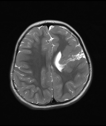 Schizencephaly | Radiology Reference Article | Radiopaedia.org