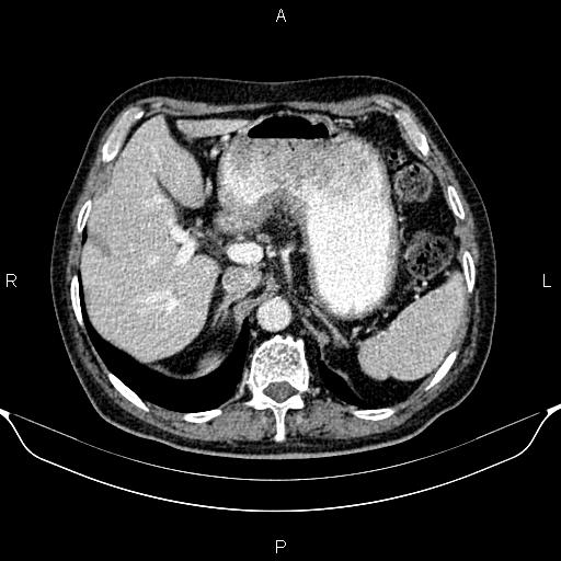 Gastric adenocarcinoma | Image | Radiopaedia.org