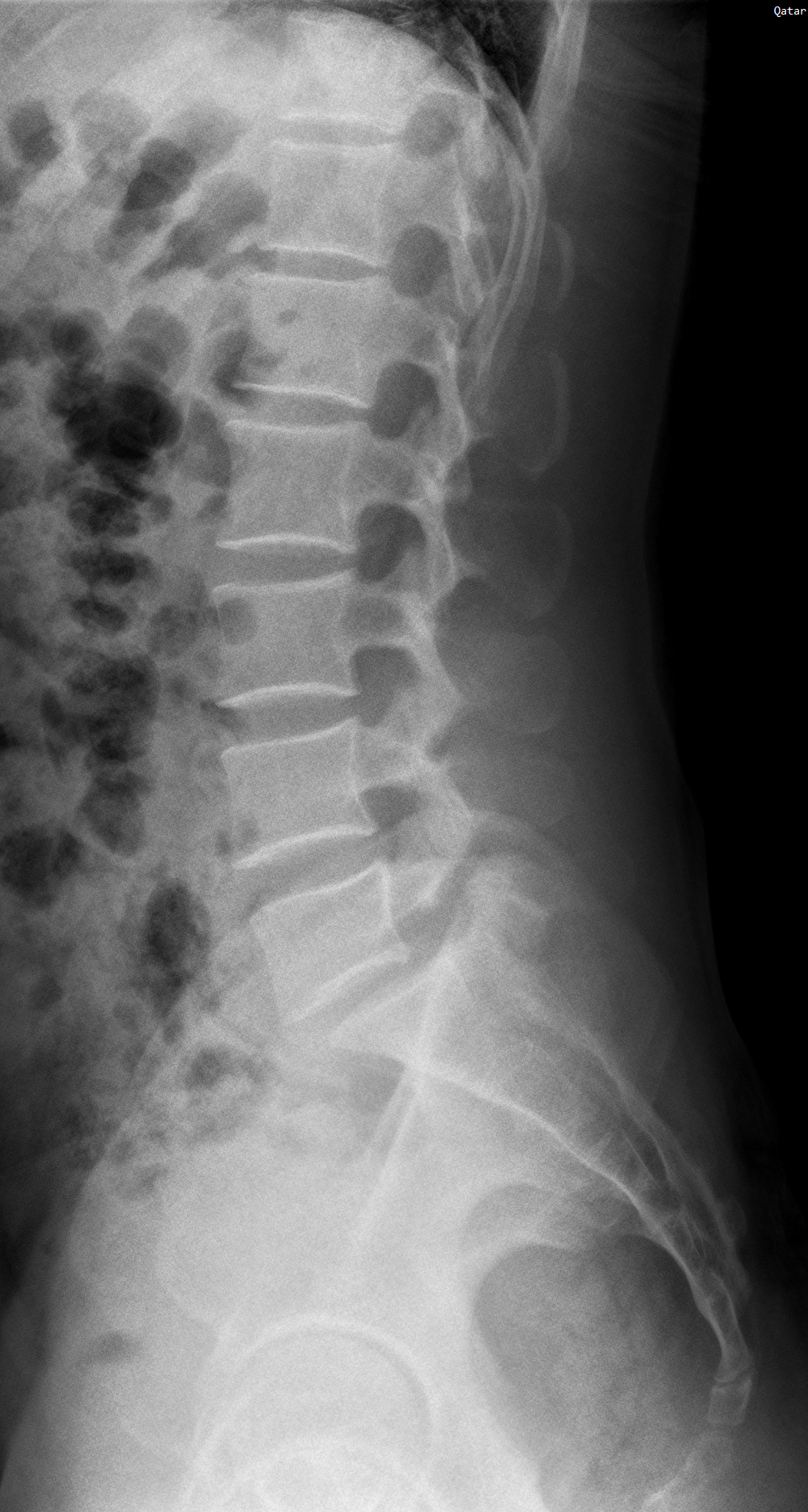 Pars Interarticularis Defect Image 2481