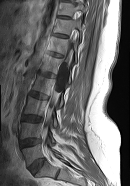 Spinal Arachnoid Cyst Image