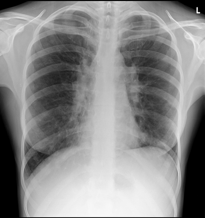 Granulomatous lymphocytic interstitial lung disease | Radiology Case ...