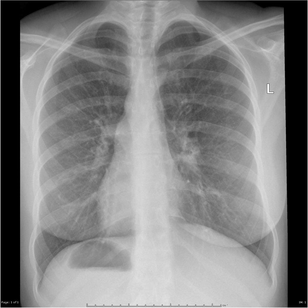 Kartagener syndrome | Radiology Case | Radiopaedia.org