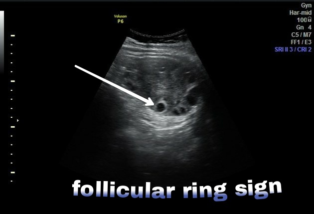 Ovarian Torsion Image