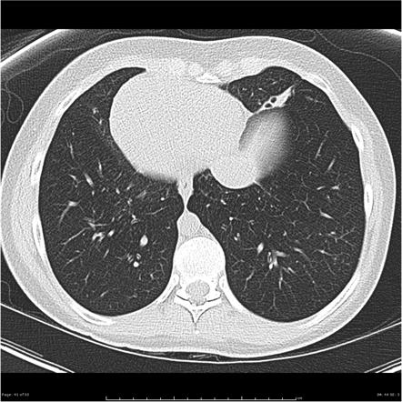 Playlist 'Primer - Paediatric Imaging - Respiratory Tract' by Aman