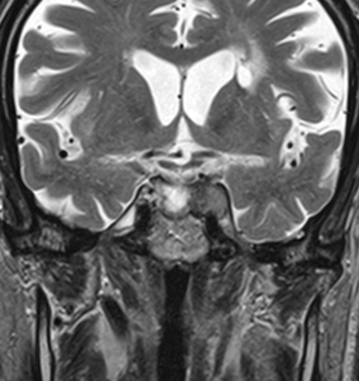 Meningiomas Cavernous Sinus And Olfactory Groove Image 