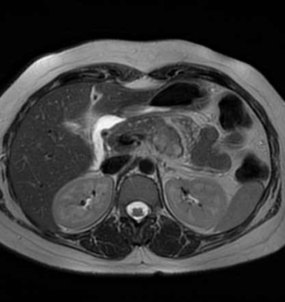 Pancreatic neuroendocrine tumor and serous cystadenoma | Image ...