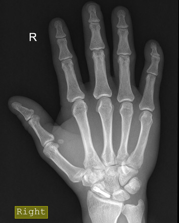 Mallet finger | Radiology Case | Radiopaedia.org