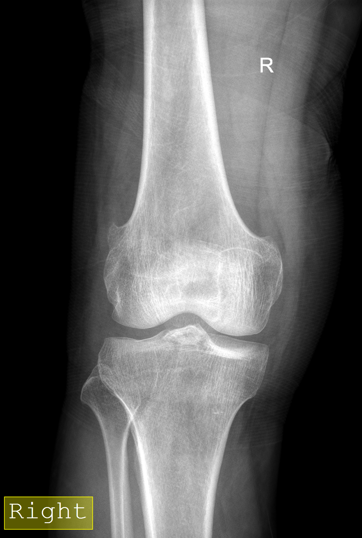 Tibial spine fracture | Image | Radiopaedia.org