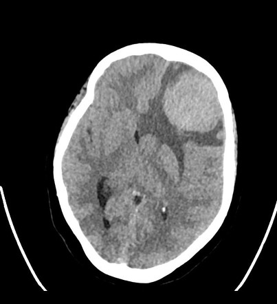 Meningothelial meningioma | Radiology Case | Radiopaedia.org