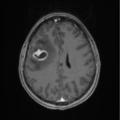 Cerebral abscess from pulmonary arteriovenous malformation | Image ...