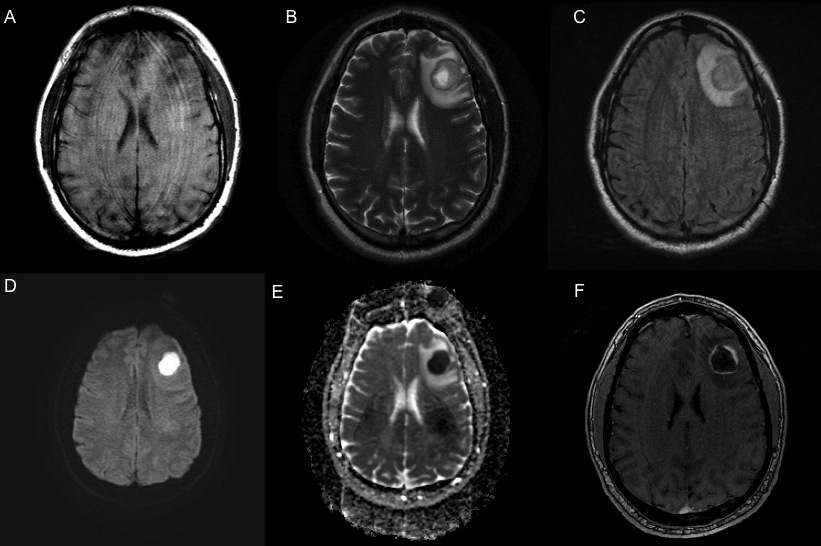 Pyogenic cerebral abscess in early capsule stage | Image | Radiopaedia.org