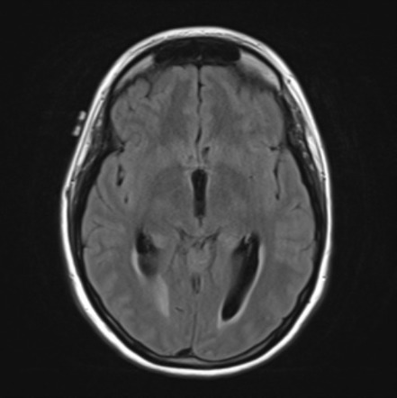 Medulloblastoma | Image | Radiopaedia.org