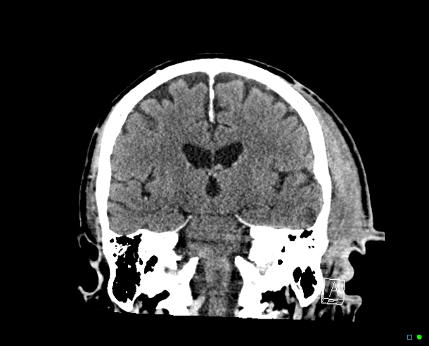 Malignant Otitis Externa Image