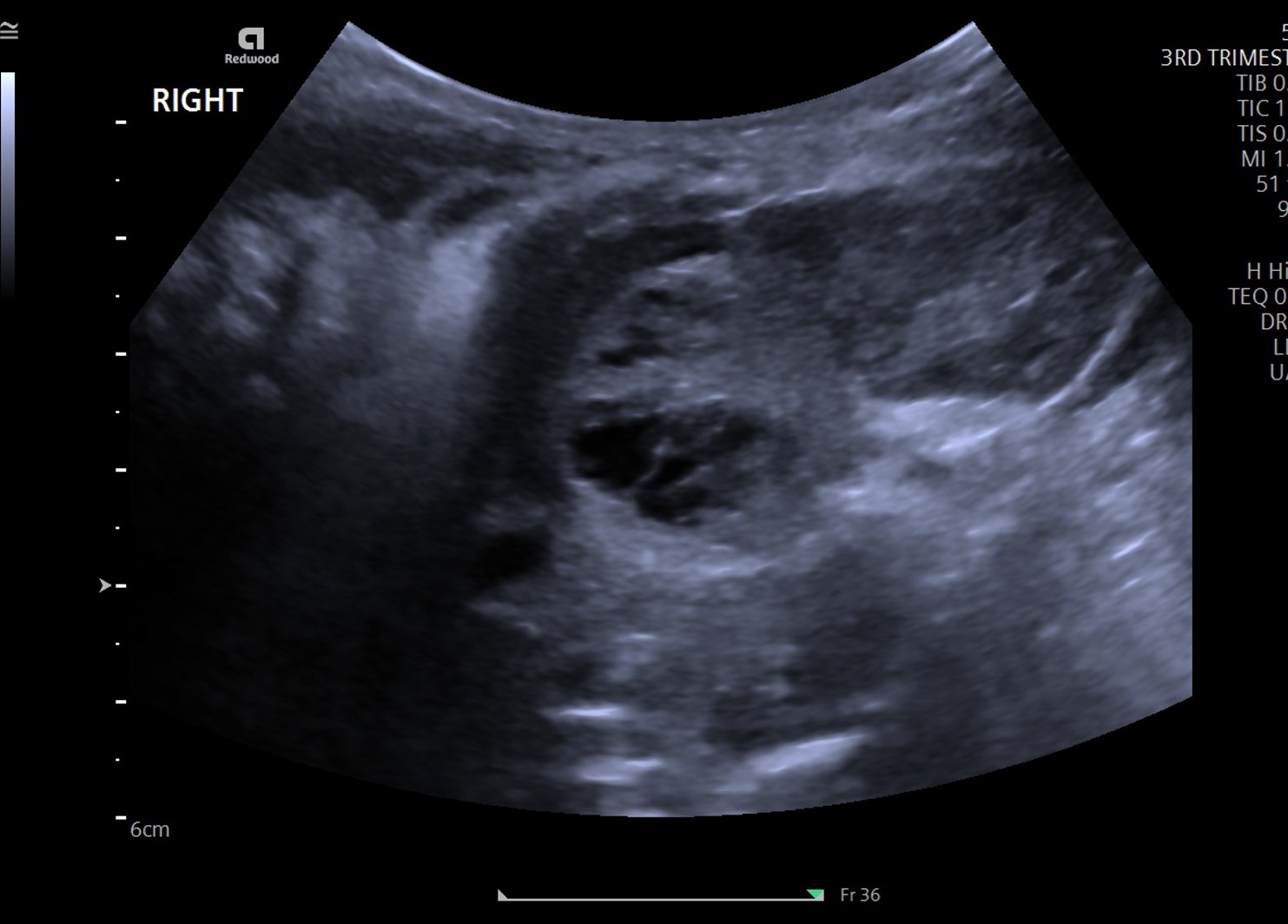 neonatal neuroblastoma presentation