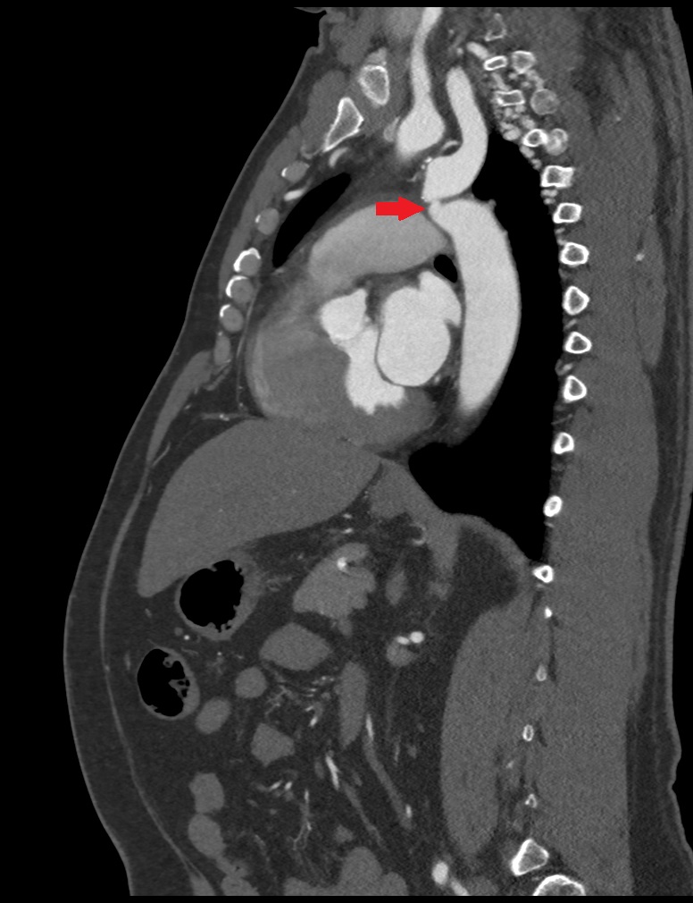 Coarctation of the aorta | Image | Radiopaedia.org