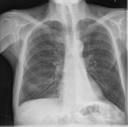 Left lower lobe collapse | Radiology Case | Radiopaedia.org