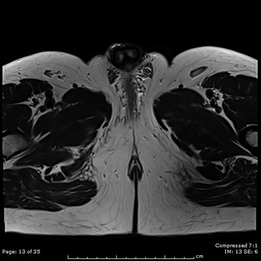 Penile Mondor disease - dorsal penile vein thrombophlebitis | Image ...