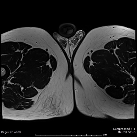 Varicocele | Radiology Reference Article | Radiopaedia.org