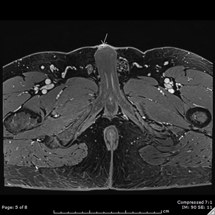 Penile Mondor disease - dorsal penile vein thrombophlebitis | Image ...