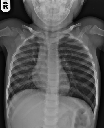 Airway foreign body | Radiology Case | Radiopaedia.org