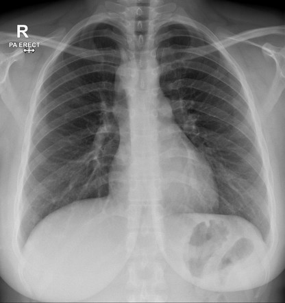 Right side aortic arch | Radiology Case | Radiopaedia.org