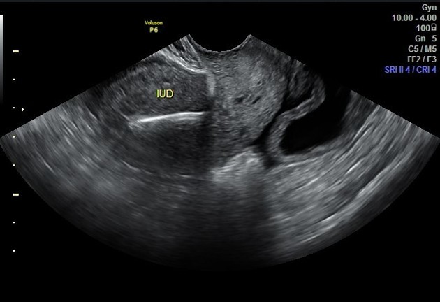 Sacro Wedgy – Female Version – Upledger Institut Österreich