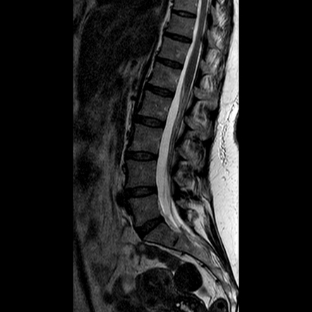 Ventrolateral Lumbar Disc Herniation With Psoas Edema 