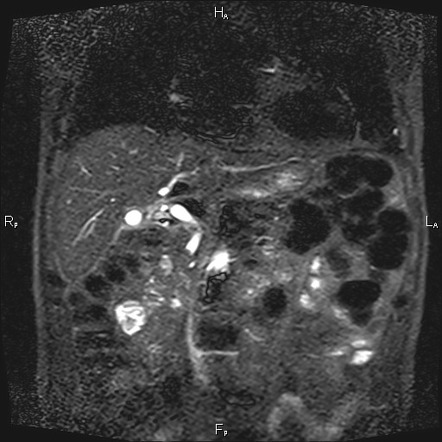 Cholelithiasis and choledocholithiasis | Radiology Case | Radiopaedia.org