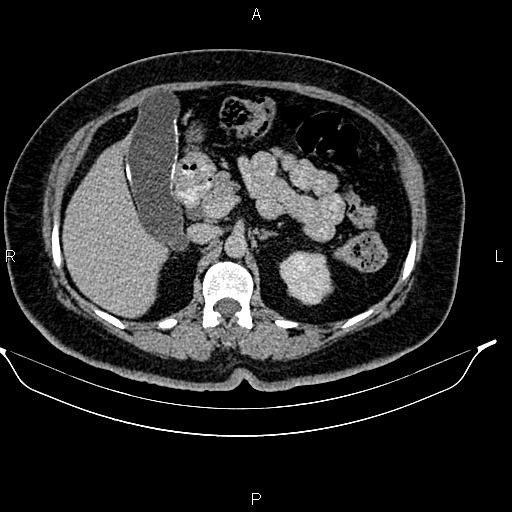 Porcelain gallbladder | Image | Radiopaedia.org